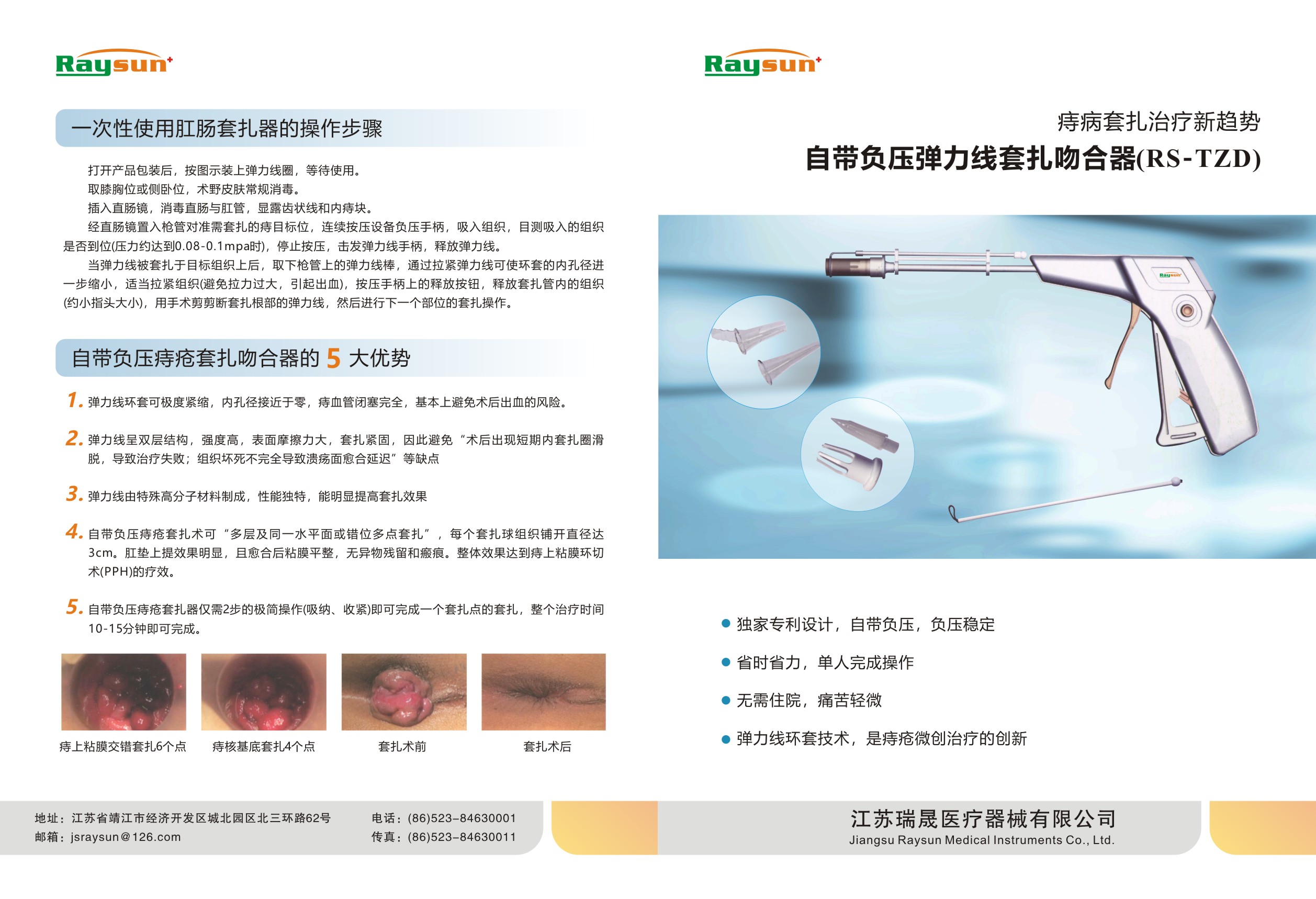 自帶負(fù)壓彈力線套扎吻合器